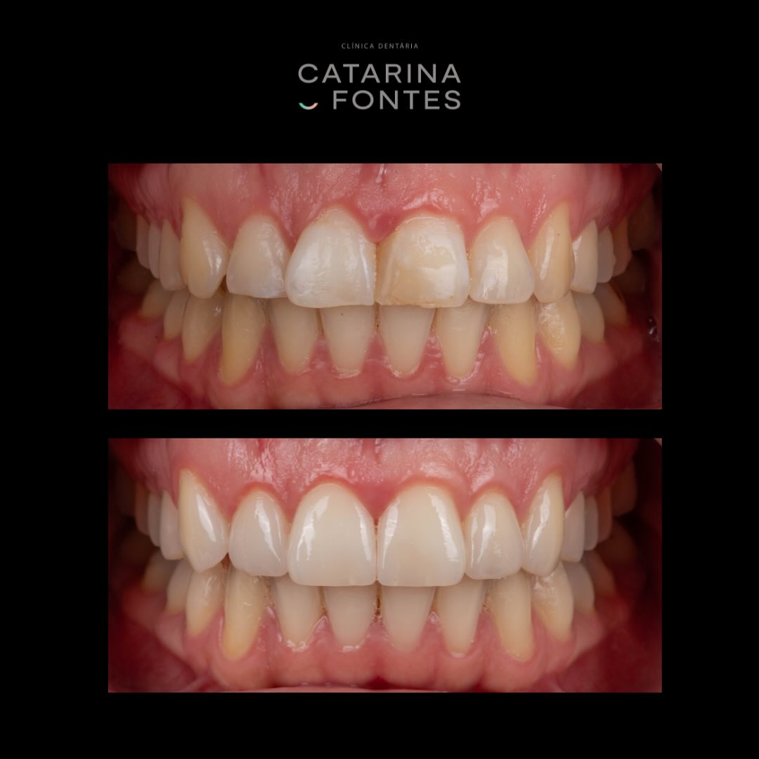 Reabilitação estética e oral - Clínica Catarina Fontes